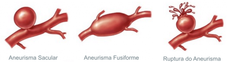 Tratamento Endovascular de Aneurisma Cerebral • Dr. Eduardo F. Raupp