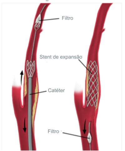 tratamento-estenose-carotida-02